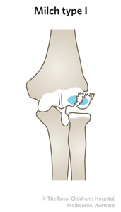 Fractrue_lateral condyle_ED_Section 2_MILCH FRACTURE 1.jpg